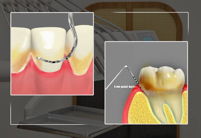 6 Indications You Need Gum Disease Treatment