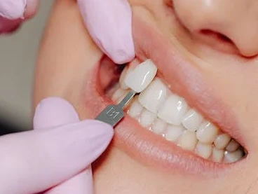 Tooth Colored Fillings Tooth Colored Fillings