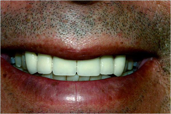 Dental Crowns and Bridges After