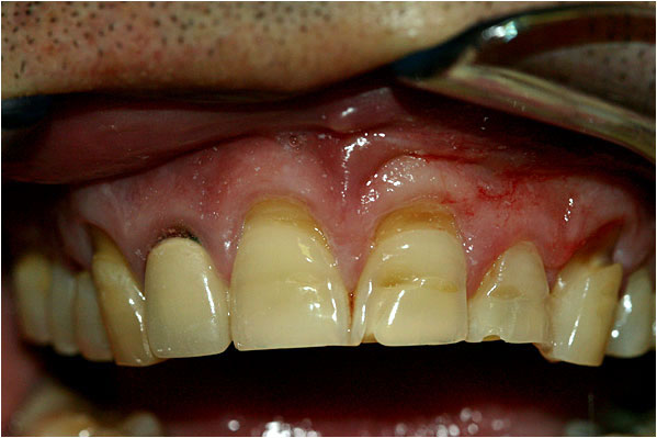 Dental Crowns and Bridges Before