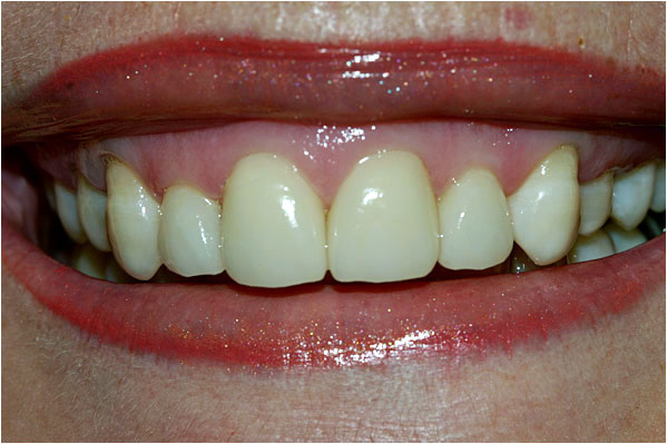 Dental Veneers After