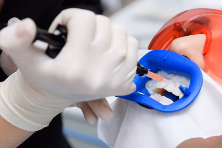 Dentist applying tooth-colored composite filling to restore a decayed tooth